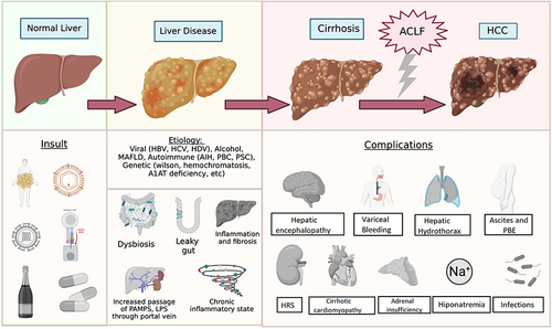 Figure 2 Complications of cirrhosis and progression of compensated cirrhosis to ACLF.Citation5–11 A compensated cirrhosis has alteration in intestinal biota, permeability, chronic inflammation, and portal hypertension. During the phase of compensated damage, the liver is subjected to numerous acute insults (alcohol, infections, bleeding, medications, etc) which at some point progress to Acute on Chronic Liver Failure (ACLF), organic failure, and high mortality.