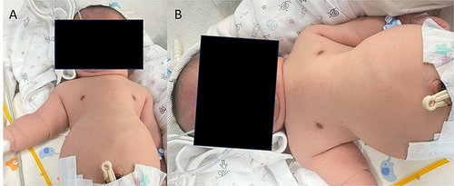 Figure 2 Clinical appearance of the patient with thoracic dysplasia. Pictures show short horizontal ribs causing severe thoracic narrowing (A and B).