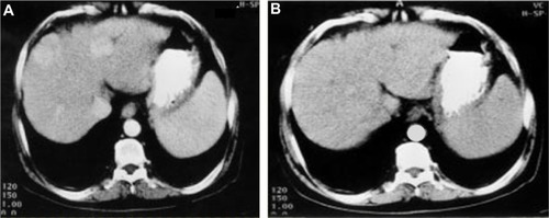 Figure 2 Postcontrast CT examination of the abdomen with a triphasic liver study of a patient before and after Ambovex® therapy showing marked tumor regression.