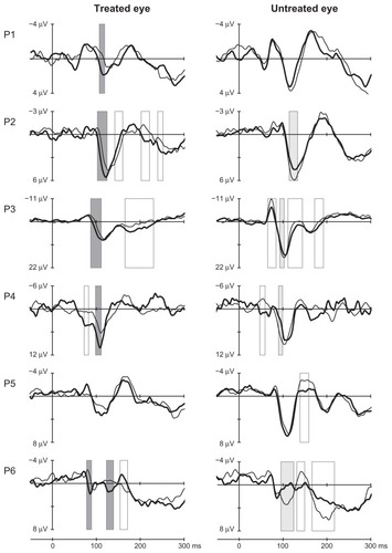 Figure 2 VEP in the Oz-FCz derivation before (thin line) and after (thick line) anti-VEFG treatment from the treated and nontreated eyes of six patients.