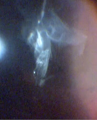 Figure 9 Intraoperative image of vitreous veils in the left eye of the elder son, an STL2 patient (Video S2).