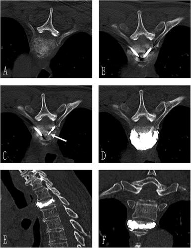 Figure 2. A 70-year-old man with T3 osteolytic metastases from lung adenocarcinoma was treated with microwave ablation combined with bone cement plasty. Preoperative axial CT showed T3 osteolytic destruction (A). The needle was inserted through bilateral costal vertebra joints, and the tip of the bone puncture needle was located in the middle 1/3 of the anterior vertebra (B). Next, the microwave antenna (arrow) was inserted through the right coaxial bone puncture needle (C), and 3 ml of bone cement was injected after microwave ablation (D). Sagittal (E) and coronal 3D CT (F) showed well-deposited bone cement in the vertebral body without extravasation.