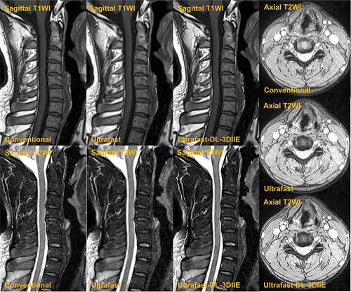 Figure 1 The example of sagittal T1-weighted (T1WI) and T2-weighted (T2WI), and axial T2-weighted images, obtained from conventional, ultrafast and ultrafast-DL-3DIIE protocols.