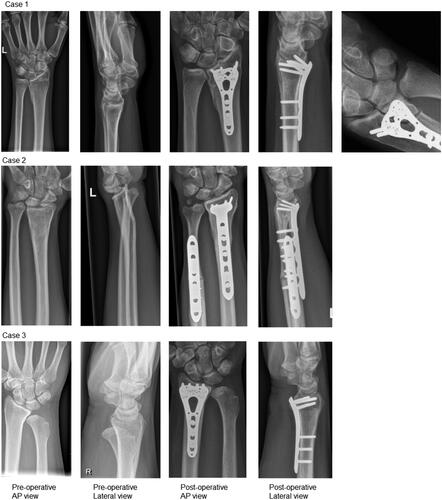 Figure 1. Radiographs of the three cases. Consecutively case 1, case 2, case 3 pre-operative and post-operative radiographs of the wrist in anteroposterior (AP) and lateral view. Post-operative scans reveal the situation after 12, 78, and 52 weeks of follow-up respectively for case 1, 2 and 3. Of case 1 an intra-operative image is displayed to show the correction of the lunate fossa.