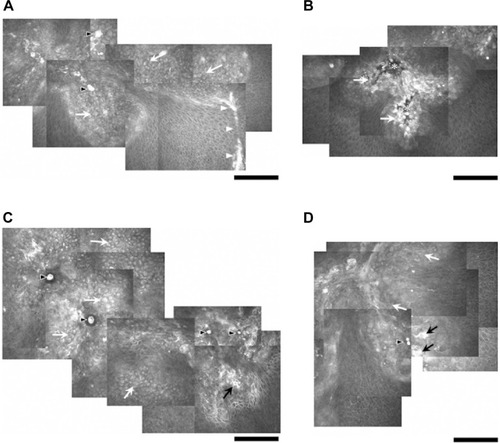 Figure 2 Subconfluent montages of in vivo confocal microscopic images at the area of dendritic lesion in Case 1 (A), Case 2 (B), Case 3 (C), and Case 4 (D). (Bar =200 μm).