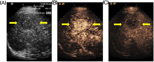 Figure 1. Grey-scale and contrast-enhanced ultrasound of hepatocellular carcinoma in a 48-year-old male patient. (a) Grey-scale ultrasonography image showing a hypoechoic hepatic nodule. (b) Contrast-enhanced ultrasound in the arterial phase (21 s) showing hyperenhancement. (c) Contrast-enhanced ultrasonography image showing hypoenhancement in the late phase at 200 s.