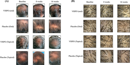 Figure 4 Representative images showing the changes in scalp hair following 16-week treatment with oral/topical VISPO formulations. (A) Representative photographs showing the vertex region of the scalp. (B) Phototrichogram analysis performed at baseline and at 8 and 16 weeks.