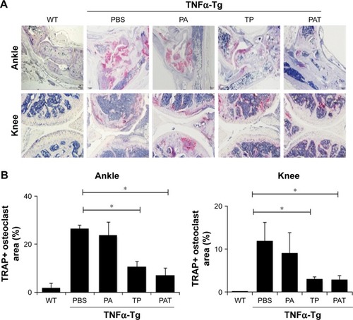 Figure 7 Both TP and PAT reduce TRAP+ osteoclast area at ankle and knee joints in TNFα-Tg mice. (A) Representative TRAP-stained sections (magnification ×40) show decreased TRAP+ osteoclasts in TP- and PAT-treated mouse. (B) Quantitation of TRAP+ osteoclast area percentage of ankle and knee joints. Values are the mean ± SD of 7–10 legs per group. *P<0.05, compared with PBS treated group.Abbreviations: WT, wild type; TNFα-Tg, tumor necrosis factor α transgenic; PBS, phosphate buffer saline; PA, poly-γ-glutamic acid-grafted di-tert-butyl L-aspartate hydrochloride; TP, triptolide; PAT, TP-loaded poly-γ-glutamic acid-grafted di-tert-butyl L-aspartate hydrochloride; TRAP, tartrate-resistant acid phosphatase.