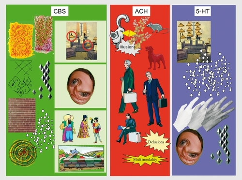 Figure 4. Caricatures of the deafferentation (CBS), cholinergic (Ach) and serotonergic (5-HT) visual perceptual syndromes. The deafferentation syndrome has three subsyndromic forms shown as light green regions, top = parietal; middle = superior temporal; bottom = ventral temporal)