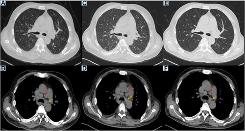 Figure 1 Chest CT (A–F). (A and B) Diffuse nodules in the lungs and multiple paratracheal lymph node enlargements on January 1, 2018. (C and D) The diffuse nodular shadows in the lungs were significantly increased, multiple lymph nodes around the trachea were enlarged and were unchanged compared with those in (A and B), and a small amount of pleural effusion was observed on January 15, 2018. (E and F) The diffuse nodules in the lungs were decreased in size, and multiple lymph nodes around the trachea had decreased in size on February 5, 2018. (red and yellow arrows indicate two enlarged lymph nodes).