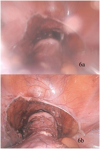 Figure 6. (a) Illustrates the development of significant fogging at a critical step in the posterior colpotomy. Following activation of OpClear (Figure 6b), there is immediate restoration of clarity.