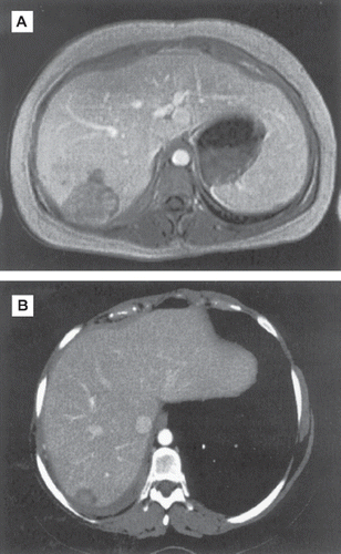 Figure 2. (A) Liver extension before chemotherapy (nodule 44 mm × 39 mm, explored by RMI). (B) Liver extension after chemotherapy (residual nodule 21 mm × 14 mm, explored by CT-scan).