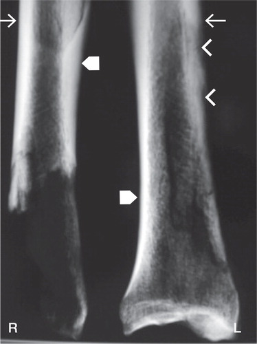 Figure 4. Conventional radiograph of right (R) and left (L) distal tibiae. Shown are expanded cortex and irregular outline along the posterior-medial aspect of the left tibia (arrowheads) as well as sclerotic distal articular surface. The right tibia has increased radiodensity corresponding to thickened cortex. Tailed arrows indicate posterior borders and block arrows indicate anterior borders.