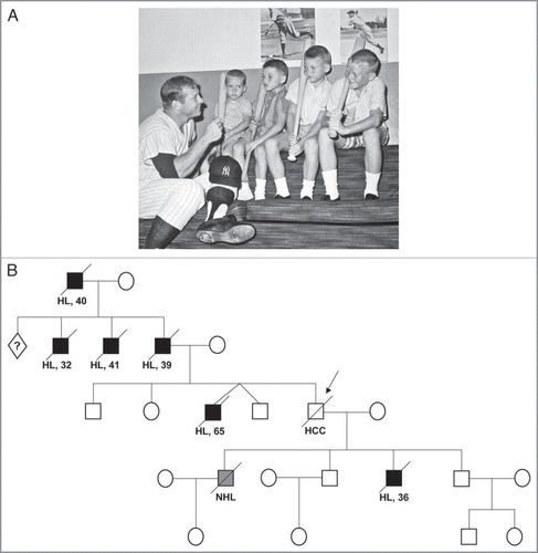 Figure 1 Gender concordance in familial Hodgkin lymphoma. (A) Mickey Mantle and his four sons. (Photo courtesy of Danny Mantle). (B) Pedigree of the Mantle family. Hodgkin (HL, black) or non-Hodgkin lymphoma (NHL, grey). HCC, hepatocellular carcinoma.