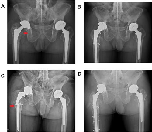 Figure 4 Radiograph of 62-year-old patient suffered from long stem breakage 6 years after the first RTHA, which was revised with a new cementless full-porous-coated long stem. (A) Aseptic loosening of right femoral stem, the arrow shows the subsidence of stem and radiolucency around prosthesis with advanced osteolysis. (B) Immediate radiograph of RTHA using full-porous-coated long stem, collar fracture was repaired with cerclage wire. (C) Long stem breakage (red arrow) occurred 6 years after revision surgery. (D) Second RTHA using cementless full-porous-coated long stem with multiple wiring ORIF.