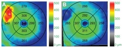 Figure 2 Cirrus HD-OCT (Carl Zeiss Meditec Inc, Dublin, CA) retinal thickness maps: at presentation showing thickening (glowing red) of an area corresponding to the cotton-wool spot (A); and 9 weeks later showing focal thinning (B).