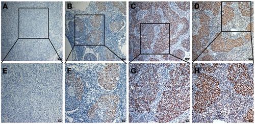 Figure 1 Expression of ZMYND8 protein in nasopharyngeal carcinoma tissue. Negative expression: (A) 10×); (E) 20×.; Weak expression: (B) 10×; (F) 20×.; Moderate expression: (C) 10×;, (G) 20×). ; Strong expression: (D) 10×; (H) 20×), .