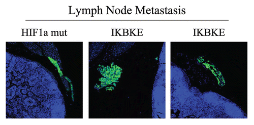 Figure 9 Visualization of peri-nodal metastatic breast cancer cells using GFP. Many of the mice co-injected with fibroblasts (GFP-negative) and cancer cells (GFP-positive) showed lymph node involvement, characterized by enlarged lymph nodes. To validate that this phenomenon was indeed related to lymph node metastasis, tissue sections were cut and used to detect the presence of GFP-positive cancer cells by GFP auto-fluorescence. Note the presence of GFP-positive cancer cells in the peri-nodal fat. Several examples are shown. Nuclei were stained with DAPI (blue color).