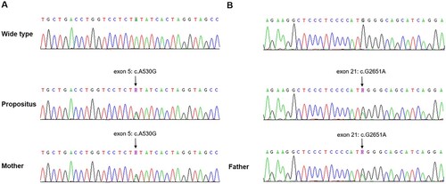 Figure 1. ADAMTS13 mutation in the patient and his parents. DNA sequence chromatograms corresponding to exon 5 and exon 21 are shown from a healthy control, the patient and his parents.