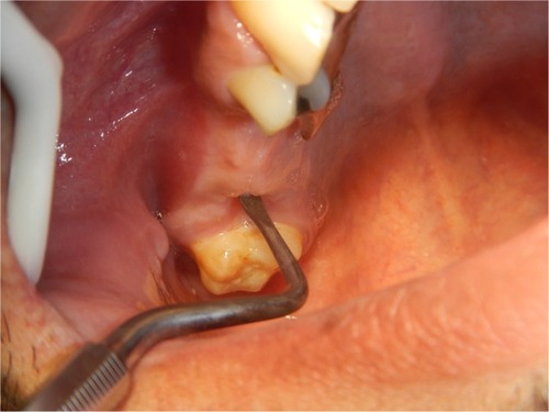 Figure 1 The fistula is clinically examined with a wide, blunt instrument to detect the site of the opening in relation to the adjacent structure.