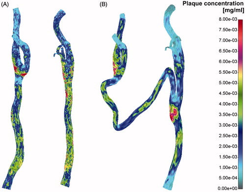 Figure 7. Plaque concentration for the pre- and post-operative case.