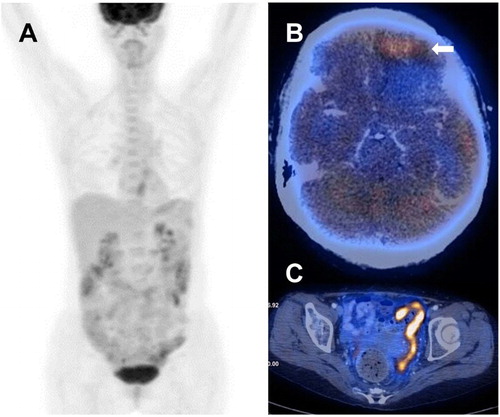 Figure 2. Patient 6, showing a change of eumetabolic lesions on presentation to hypermetabolic lesions during disease progression. (A) PET/CT at diagnosis, showing absence of hypermetabolic lesion, despite pathologically proven involvement of the colon. (B) Axial image at disease progression, showing hypermetabolic tumour at left frontal lobe (arrow). (C) Axial images at relapse, showing hypermetabolic sigmoid thickening with extension of disease to pelvic peritoneum.