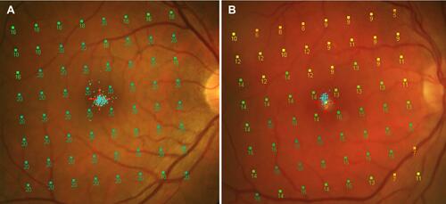 Figure 3 PPole MP1 map of a healthy control and a patient with Parkinson’s disease. (A) PPole MP1 map showing normal values in the right eye of a HC. (B) PPole MP1 map showing a decrease in DLS values throughout the whole pattern in the right eye of Patient with PD.