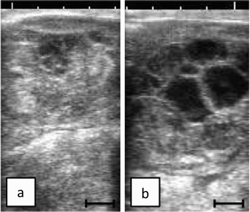 Figure 1. Ultrasonographic appearance of affected left ovary. On D5, the left ovary revealed mass with solid appearance (a). On D22, the left ovary become enlarged and merged multicystic appearance (b). Bar = 10 mm.