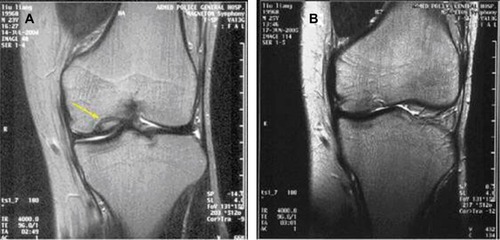 Figure 1 MRI of the knee joint before and after the MACI operation.