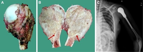 Figure 4 Postoperative images of this patient. (A and B) show the tumor specimen. The tumor arose within the medullary cavity of the proximal humerus and there is a sclerotic margin that separates the tumor from the normal medullary structures (red arrow); (C) Postoperative X-ray showed the location of the prosthesis was good, without dislocation.