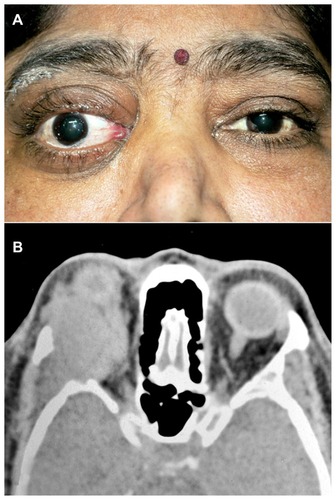 Figure 1 External photograph and axial CT scan of the same patient. External photograph of the patient showing right eye proptosis with periocular swelling and mild conjunctival congestion (A). CT scan, axial cut, of the same patient showing a large mass occupying the lateral quadrant of the orbit with erosion of the lateral wall and extension into the temporal fossa (B).