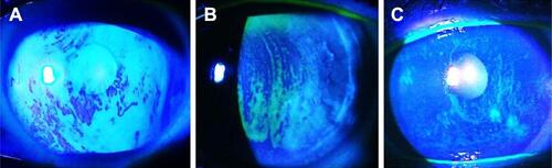 Figure 3 Different patterns of TFBUT at different time elapsed after blinking in patients with (A) staphylococcal blepharitis, (B) MGD, and (C) Sjögren syndrome with associated MGD.