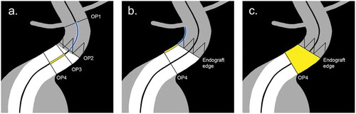 Figure 2. Schematic representation of published methods for determination of endograft apposition with the arterial wall, and position relative to the target vessels. The figure displays the proximal landing zone for EVAR, but the methods also apply to both proximal and distal landing zones for EVAR and TEVAR. Method A defines the length over the centerline between two orthogonal planes. Endograft position is measured from the orthogonal plane through the orifice of the target vessel (OP1) and the orthogonal plane through the top of the endograft fabric (OP2). Endograft apposition is measured from the orthogonal plane with full proximal (OP3) and distal (OP4) circumferential apposition. Method B defines the length between 3D coordinates over the arterial wall with dedicated post-processing software. Endograft position is calculated as the shortest distance between the target vessel and the endograft fabric edge circumference. Endograft apposition is calculated as the shortest distance between the endograft fabric edge circumference and the distal apposition circumference in the orthogonal plane (OP4). Method C defines the apposition surface area between the endograft fabric edge circumference and the distal apposition circumference in the orthogonal plane (OP4), which is calculated automatically by dedicated post-processing software.