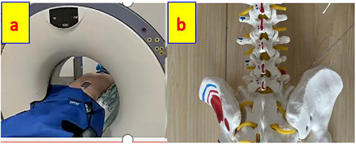 Figure 1 The patient was laid in the prone position on the CT imaging bed, with a pillow under the abdomen, the positioning grid was fixed on the surgical area with adhesive tape as (a) CT (Siemens Joy single row, parameter 81 mas/80 kV) vertical scanning was used to locate the plane of the L5-S1 intervertebral space. The plasma needle attempt to reach the disc plane require tilt angle puncture as shown in (b).