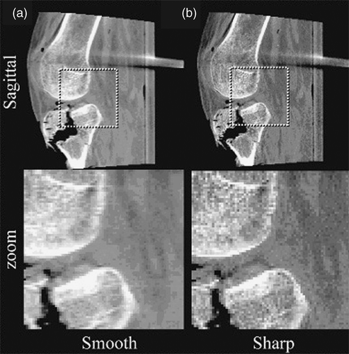 Figure 8. Example images reconstructed using (a) “Smooth” and (b) “Sharp” reconstruction filters. Overall image quality is superior for the Sharp filter, particularly for identification of subtle fracture components and trabecular structure. The Smooth filter provides somewhat improved delineation of soft-tissue structures.