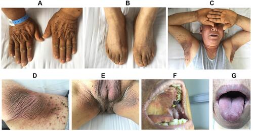Figure 1 Acanthosis nigricans on the surfaces of hands (A), feet (B), axilla (C and D), inguinal area (E) and oral cavity (F and G).