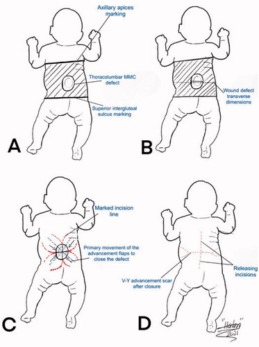 Figure 3. A drawing illustration explaining the marking of the V-Y rotation advancement flap. A. The axillary apices marking including most cranial point of the intergluteal sulcus, and posterior axillary lines forming a rectangular field shape. B. Drawing of the transverse dimensions on the wound defect. C. Quadruple flap drawing: the longest diameter of every V-Y rotation, and advancement flap dimension is one and a half more than half of each bisector of the defect. D. V-Y advancement scar after closure as well as the releasing incision scars at the top and bottom of the flaps.
