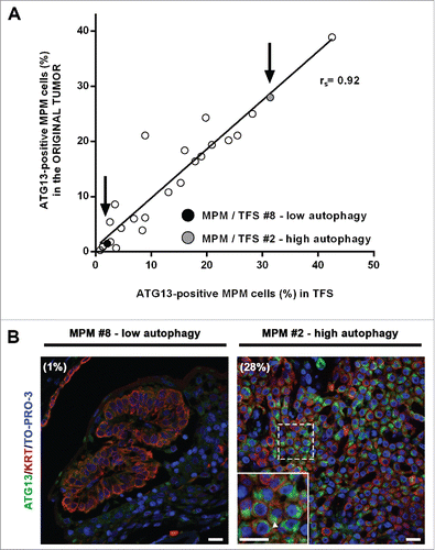 Figure 7. In tumor fragment spheroids, autophagy initiation correlates with that of the original tumors. Fixed samples of the original tumors used to generate the analyzed 25 TFS were stained for ATG13 (green), KRT/cytokeratin (red) and nuclei (blue) and imaged by confocal microscopy. (A) The correlation plot of the percentages of ATG13-positive MPM cells measured in formalin-fixed MPM clinical samples (y axis) relative to those measured in the respective TFS (x axis) is shown. Arrows identify the position of the representative low autophagy (MPM or TFS #8, black circle) and high autophagy (MPM or TFS #2, gray circle) tumor, previously shown in Figures 4,5, and 6. Spearman rank correlation (rs), 0.9253; P (2-tailed)< 0.0001. (B) Representative images of MPM sections corresponding to TFS with either low autophagy (MPM #8) or high autophagy (MPM #2) levels are shown, with the percentage of mesothelioma cells with ATG13 puncta (ATG13-positive MPM cells) indicated in parentheses. Zoom-in view of the region in the dashed box shows representative cells with ATG13 puncta (arrowhead). Scale bars: 10 µm.