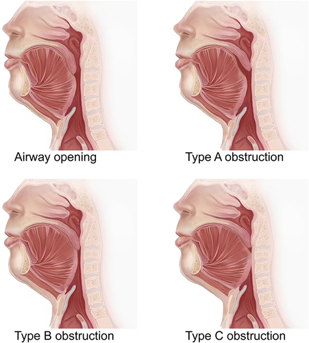 Figure 2 Schematic diagram of upper airway opening and different types of obstruction.