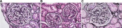 Figure 1 The main histopathologic phenotypes of HBV-GN. (A) Membranous nephropathy (MN) (Jones’ silver stain ×200); (B) Mesangioproliferative glomerulonephritis (MPGN) (Jones’ silver stain ×100); (C) Mesangial proliferative glomerulonephritis (MsPGN) (Jones’ silver stain ×200).