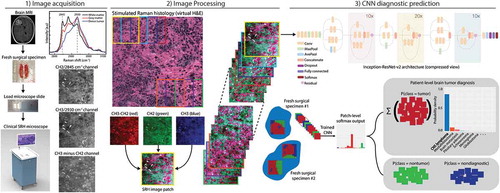 Figure 1. The SRH-CNN pipeline for automated intraoperative brain tumor diagnosis. (1) A patient newly diagnosed with a brain lesion undergoes a brain biopsy or planned resection. Fresh tissue is loaded directly into a stimulated Raman histology (SRH) imager for image acquisition. Images are acquired at two Raman shifts, 2,845  cm−1 and 2,930  cm−1, and a third image channel is generated via pixel-wise subtraction. Time to acquire a 1 × 1-mm2 SRH image is approximately 2 min. (2) A dense sliding window algorithm generates image patches that are preprocessed to optimize image contrast. (3) Each patch undergoes a feedforward pass through the network. Our inference algorithm is designed to retain the patches with high probability of being diagnostic, filtering the regions that are normal or nondiagnostic. Patch-level predictions from tumor regions are then summed and renormalized to generate a patient-level probability distribution over the diagnostic classes. Our pipeline can provide tissue diagnoses in <2.5 min using a 1 × 1-mm2 image, decreasing time to diagnosis by a factor of 10 compared with conventional intraoperative histology.MRI, magnetic resonance imaging; H&E, hematoxylin and eosin; CNN, convolutional neural network.