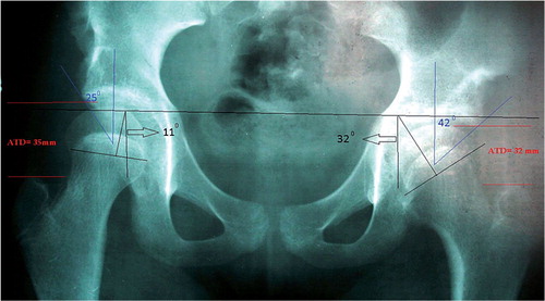 Figure 3. Postoperative epiphyseal and acetabular coverage angles in the same bilateral type-II AVN patient. There is significant correction on the left side.