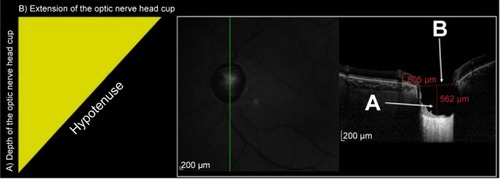 Figure 1 Measurement of the hypotenuse of the vertical optic nerve head cup using the depth (A) and length (B) of the cup as the sides of a right-angled triangle whose hypotenuse is calculated by the Pythagorean theorem.