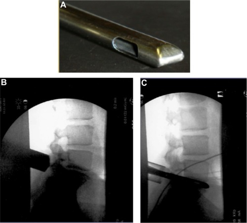 Figure 5 Close up of the bone graft delivery tool tip and its radiographic appearance.