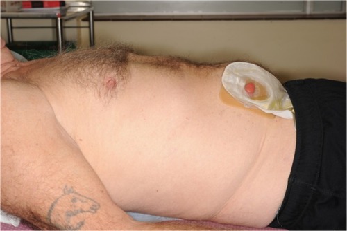 Figure 2 Postoperative photo of patient with ileal conduit in situ.