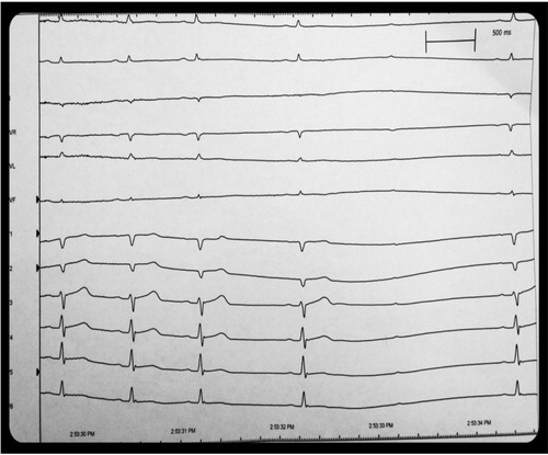 Fig. 1 Cardiac monitoring following ingestion of 500 ml of a cold carbonated beverage. The patient had marked sinus bradycardia of 30 beats per minutes after the one sip. Following the bradycardia was a 3.5-second sinus pause with second-degree Mobitz Type 1 AV block. He complained of near syncope during the event.