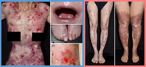 Figure 1 Clinical manifestations of DEB patients. (A) Generalized blistering and ulceration, (B) microstomia, (C) pseudosyndactyly, and (D) cutaneous squamous cell carcinoma, in RDEB. (E and F) Scattered, semi-confluent, erythematous or hyperpigmented prurigo-like papules and plaques of varying severity, as well as toenail dystrophy, in DDEB.