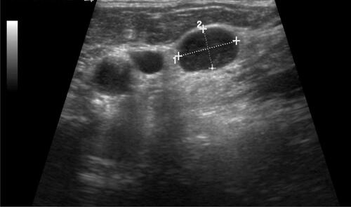 Figure 1 Ultrasound image of involved lymph nodes.