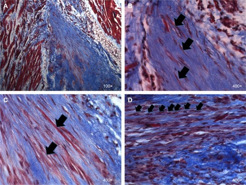Figure 2 Evidence for new tissue formation in VML injuries repaired with TEMR–MDC constructs.Notes: LD muscles repaired with TEMR–MDC (n=10) constructs were retrieved 2 months postimplantation, paraffin embedded and processed for Masson’s trichrome staining, and analyzed for morphology and new tissue formation. Red indicates muscle, blue indicates collagen, and black indicates nuclei in Masson’s trichrome staining. (A) An overview at the interface of native tissue and scaffold. (B) Arrows indicate regenerating striated muscle fibers. (C) Arrows indicate long, differentiated MDCs and neofibers on the scaffold, whereas arrows in (D) indicate fusion of MDCs to form new muscle fibers.Abbreviations: VML, volumetric muscle loss; TEMR, tissue-engineered muscle repair; MDC, muscle-derived progenitor cell; LD, latissimus dorsi.