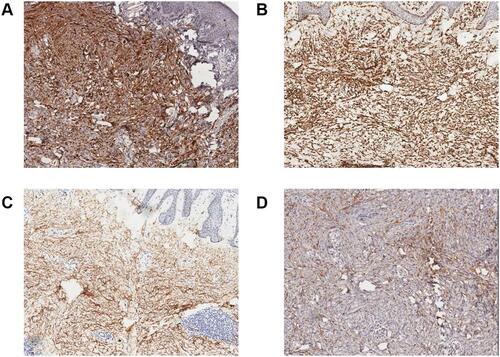 Figure 3 Immunophenotype of desmoplastic melanoma (IHC with SP method, × 100). (A) Diffuse, positive expression of S-100; (B) diffuse, positive expression of vimentin; (C) diffuse, positive expression of CD34; (D) positive expression of Melan-A.